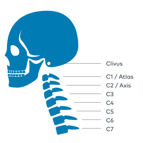 Clival and upper cervical spine side effects Chordoma Foundation